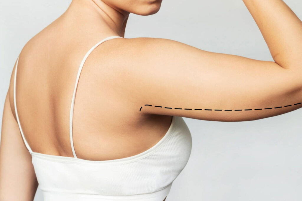 Oberarmstaffung - Dr. Nichlos