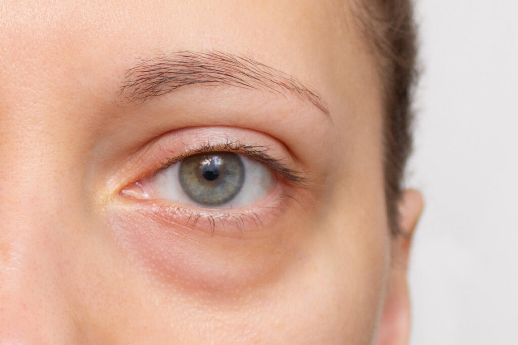 Nahaufnahme Auge mit sichtbaren Tränensäcken am Unterlid